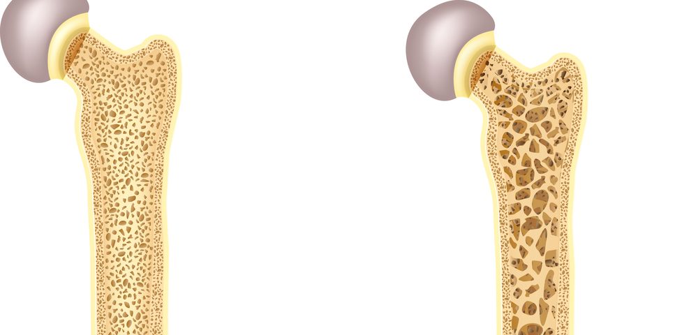 Evista For Osteoporosis
